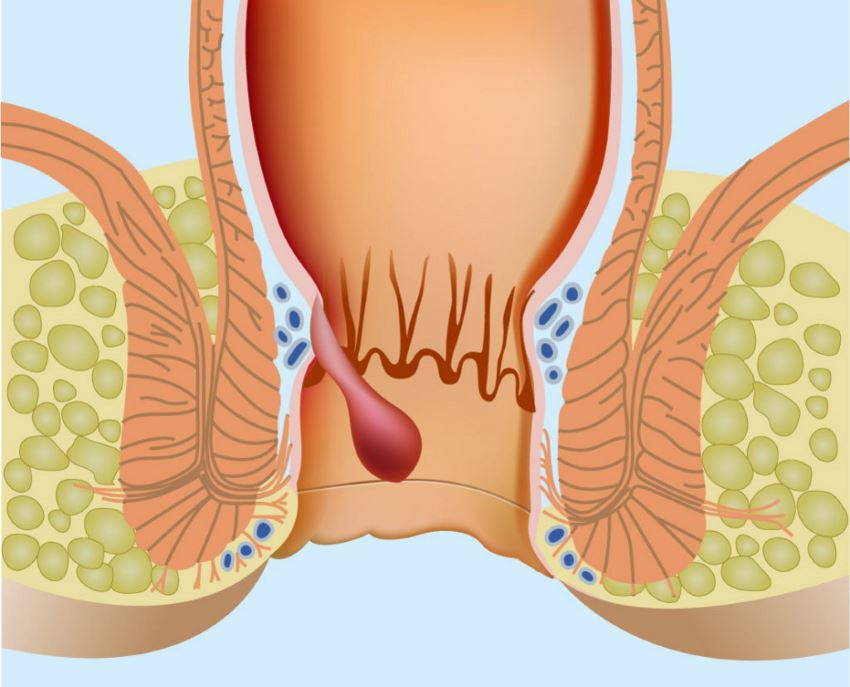 Cirujanos Gastroenterólogos de Celaya | Artículos | Hemorroides